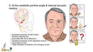 Course of facial nerve