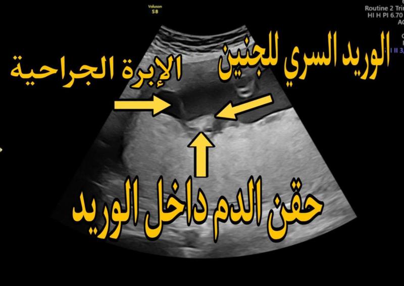 Four intrauterine blood transfusion sessions save a fetus from severe anemia at Assiut University’s Women's Health Hospital.